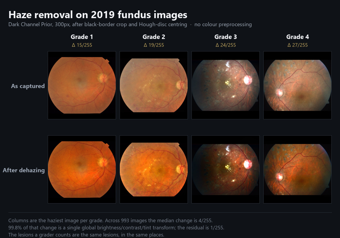 Fundus images before and after Dark Channel Prior dehazing